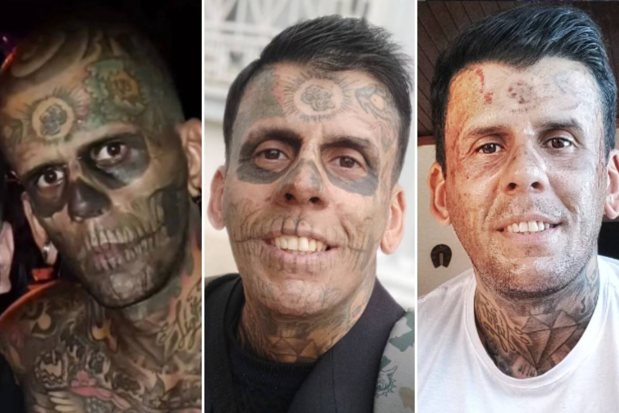 Homem conhecido como o mais tatuado do Brasil passa por cirurgia para retirar tumor na bexiga