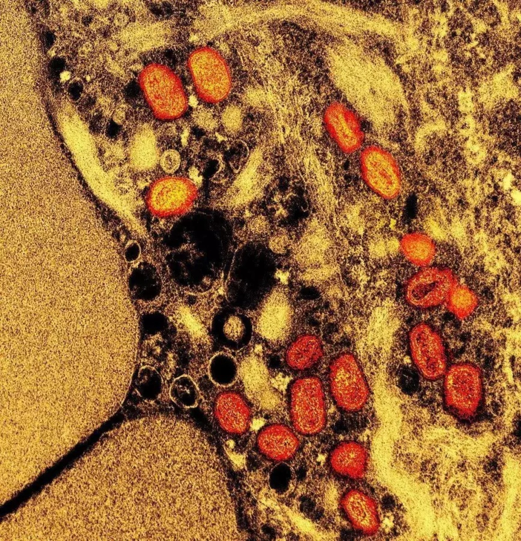 Brasil chega a 140 casos confirmados de mpox em 2026; veja lista por estado